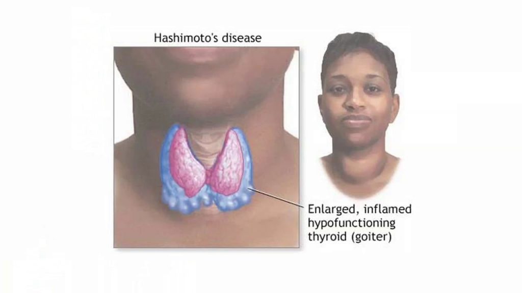 A Comprehensive Guide To Goitrogens And Hashimotos