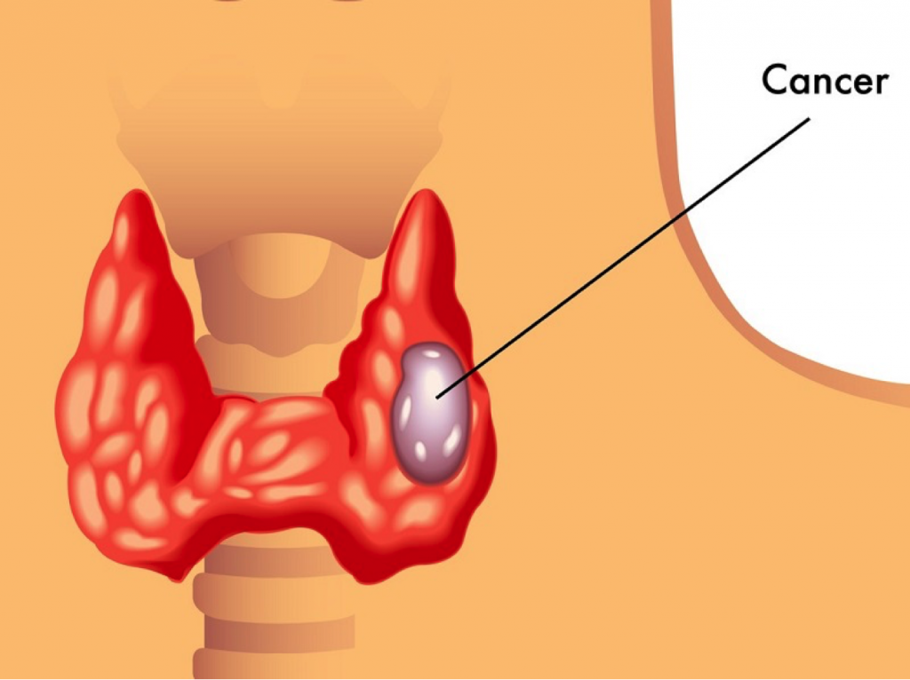 thyroid cancer