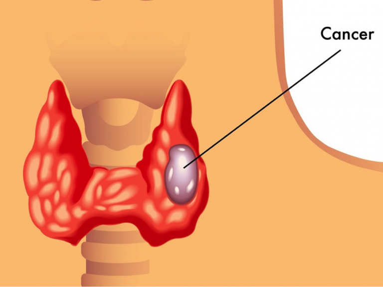 Thyroid Cancer A Comprehensive Guide and The Top 6 Ways To Prevent It