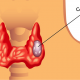 thyroid cancer