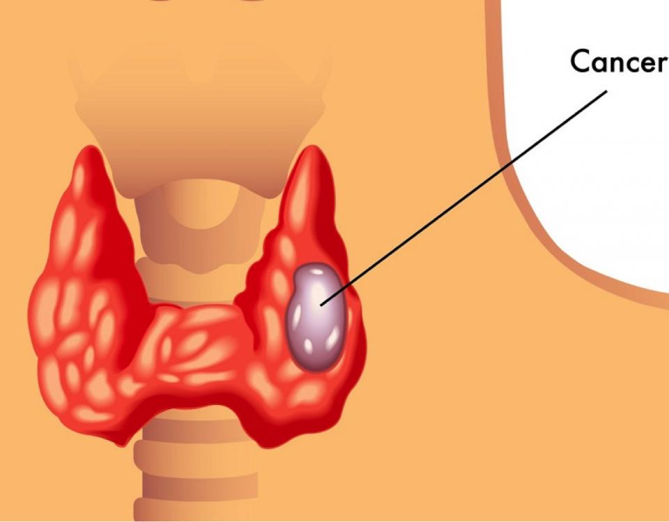 thyroid cancer